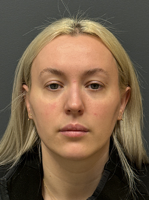 1 week post NanoLaserPeel