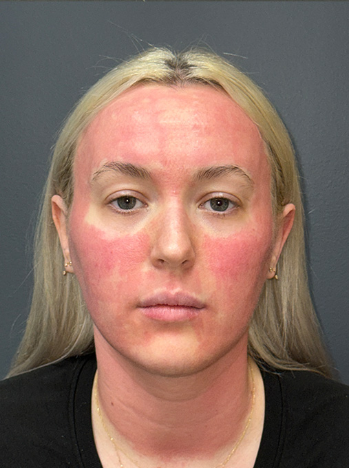1 week post NanoLaserPeel