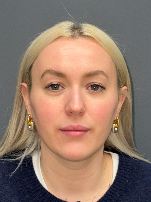 1 week post NanoLaserPeel