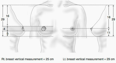 Breast Reconstruction Washington DC