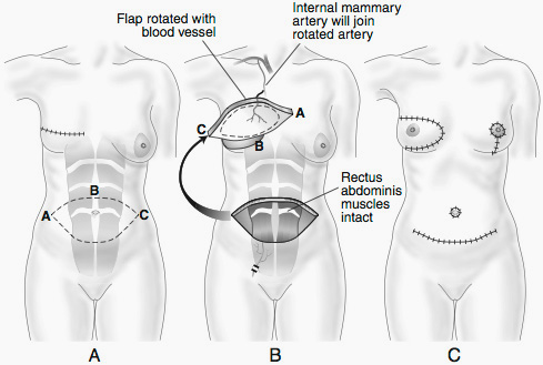 Breast Reconstruction Washington DC