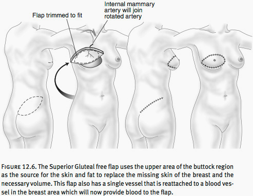 Breast Reconstruction Washington DC