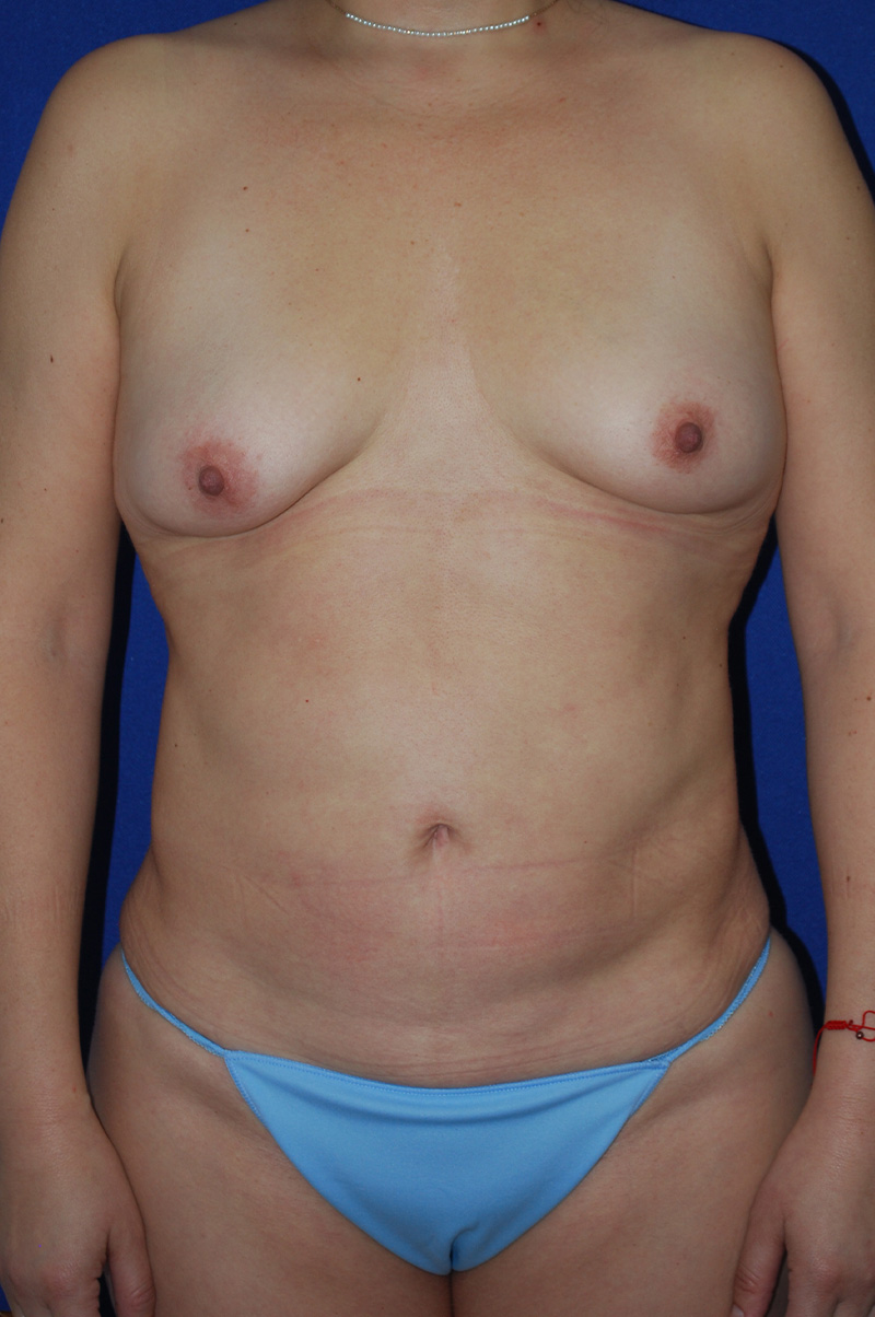 Mommy Makeover Before and After | Plastic Surgery Institute of Washington