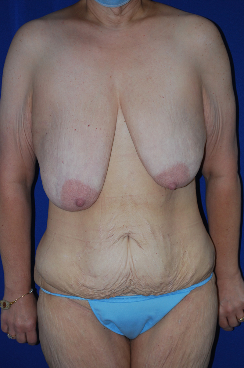 Mommy Makeover Before and After | Plastic Surgery Institute of Washington