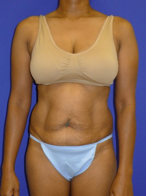 Mommy Makeover Before and After | Plastic Surgery Institute of Washington