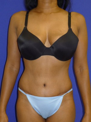 Mommy Makeover Before and After | Plastic Surgery Institute of Washington