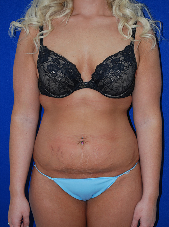 Mommy Makeover Before and After | Plastic Surgery Institute of Washington