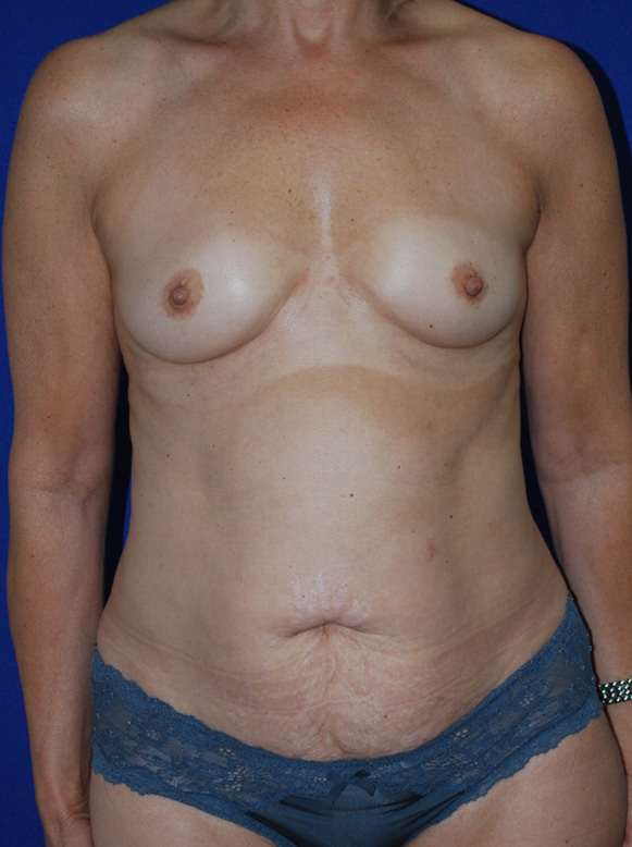 Mommy Makeover Before and After | Plastic Surgery Institute of Washington