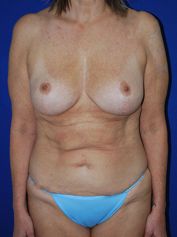 Mommy Makeover Before and After | Plastic Surgery Institute of Washington