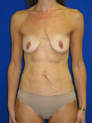 Mommy Makeover Before and After | Plastic Surgery Institute of Washington