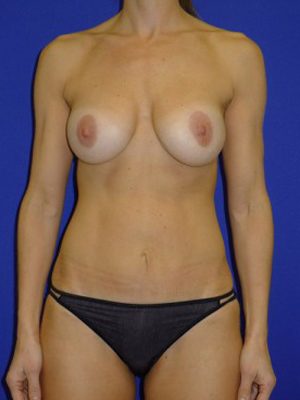 Mommy Makeover Before and After | Plastic Surgery Institute of Washington