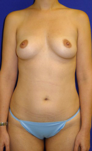 Mommy Makeover Before and After | Plastic Surgery Institute of Washington