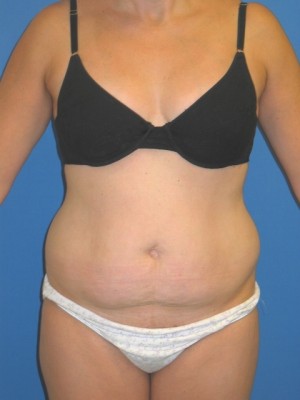 Mommy Makeover Before and After | Plastic Surgery Institute of Washington