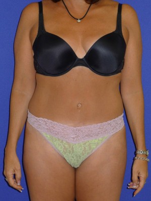 Mommy Makeover Before and After | Plastic Surgery Institute of Washington