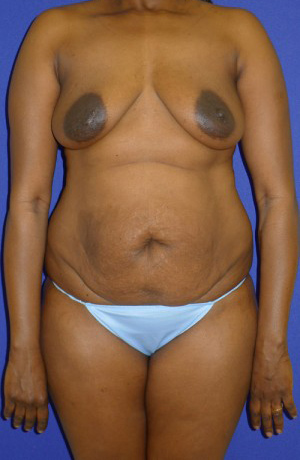 Mommy Makeover Before and After | Plastic Surgery Institute of Washington