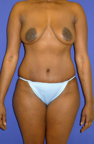 Mommy Makeover Before and After | Plastic Surgery Institute of Washington