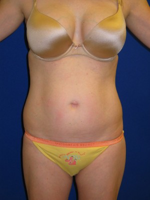 Mommy Makeover Before and After | Plastic Surgery Institute of Washington