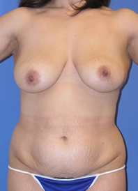 Mommy Makeover Before and After | Plastic Surgery Institute of Washington