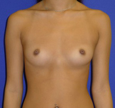 Breast Augmentation Washington DC Before & After