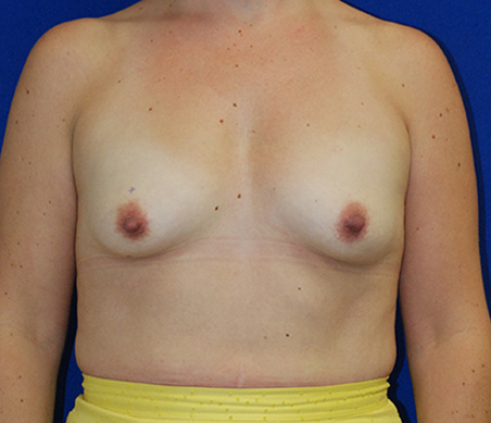 Breast Augmentation Washington DC Before & After