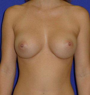 Breast Augmentation Washington DC Before & After