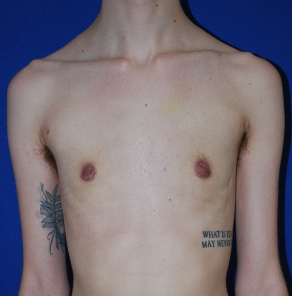 Topectomie Top Surgery Before and After | Plastic Surgery Institute of Washington