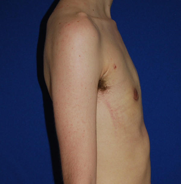Topectomie Top Surgery Before and After | Plastic Surgery Institute of Washington