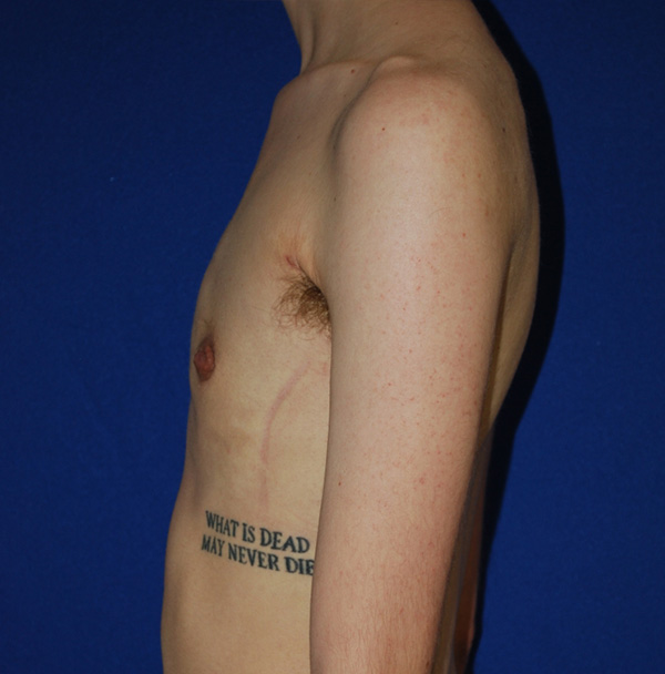 Topectomie Top Surgery Before and After | Plastic Surgery Institute of Washington