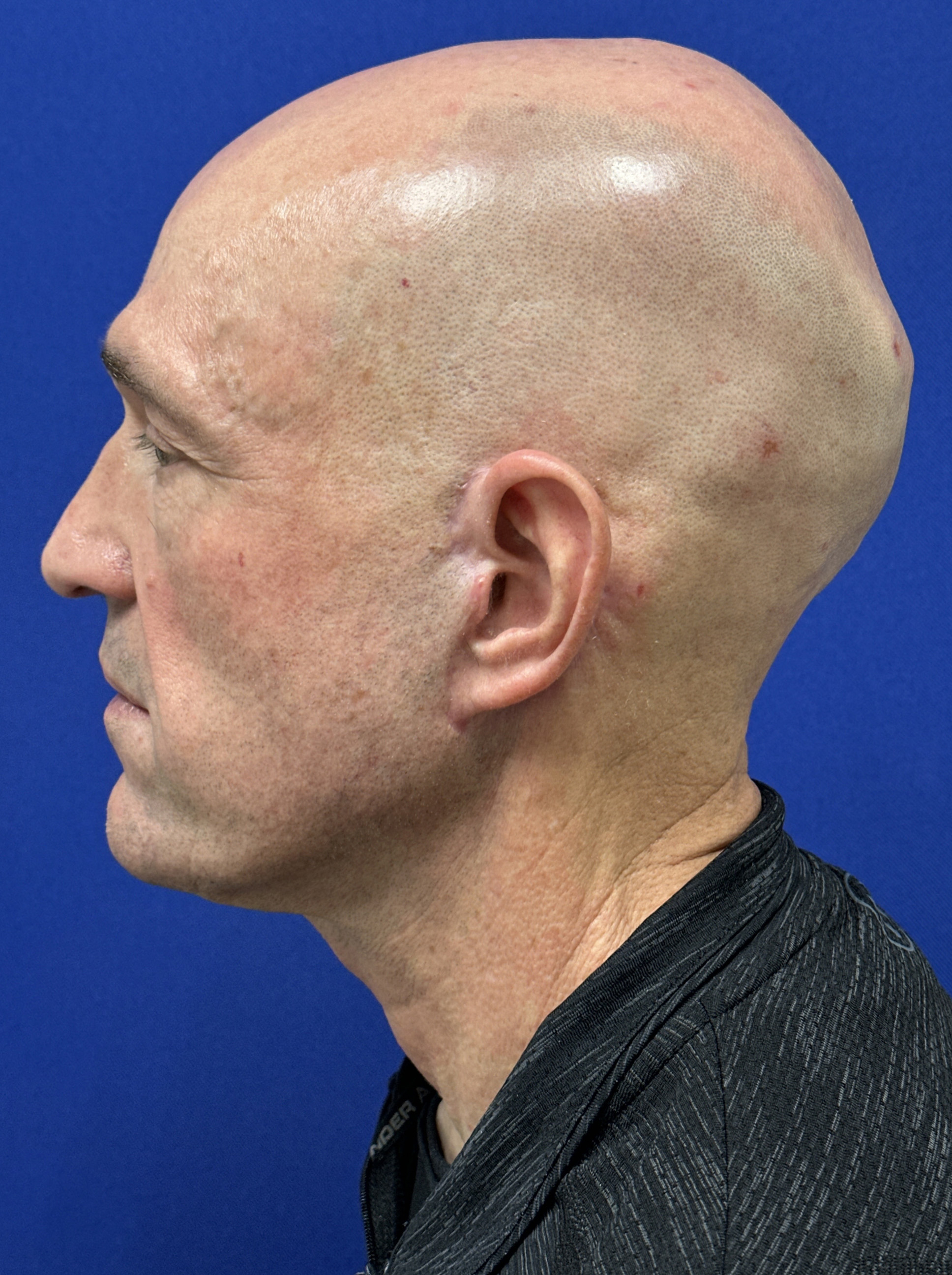 Face And Eyes Before and After | Plastic Surgery Institute of Washington