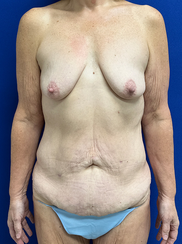 Breast Augmentation Washington DC Before & After