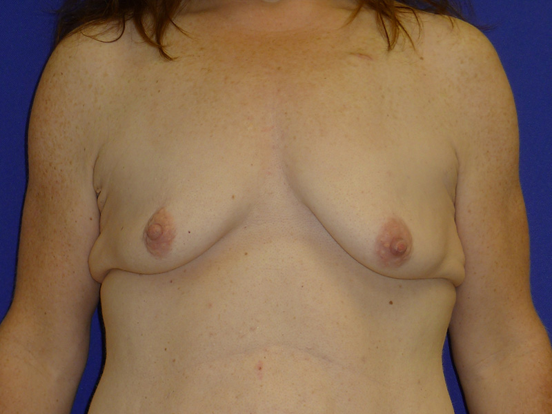 Breast Augmentation Washington DC Before & After