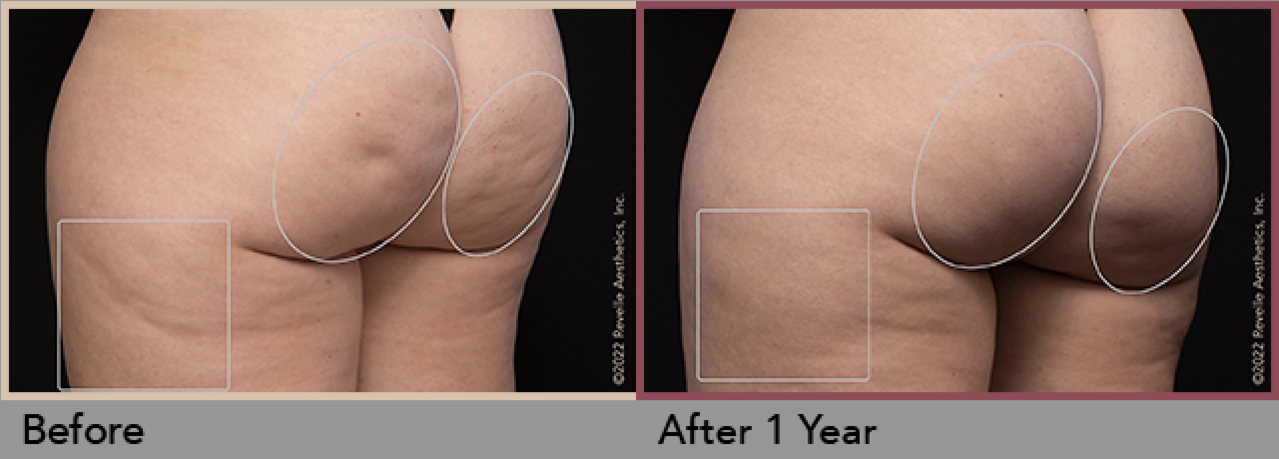 Avéli™ Long-Term Cellulite Reduction Procedure