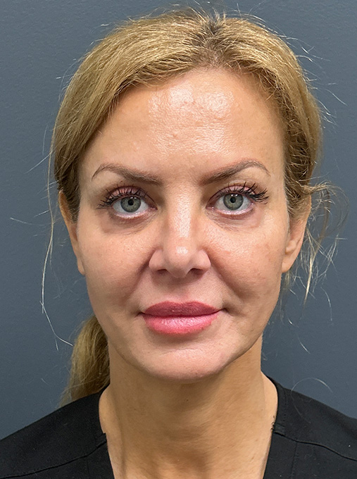 1 week post ProFractional Laser