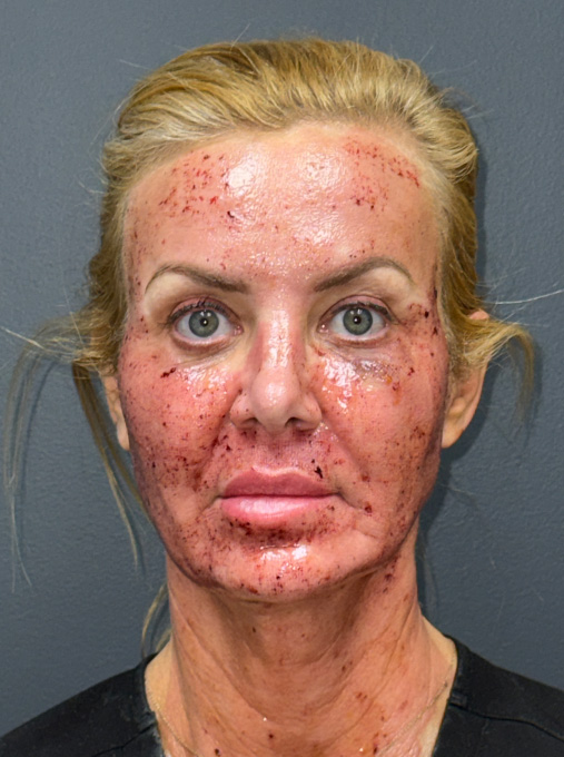 1 week post ProFractional Laser