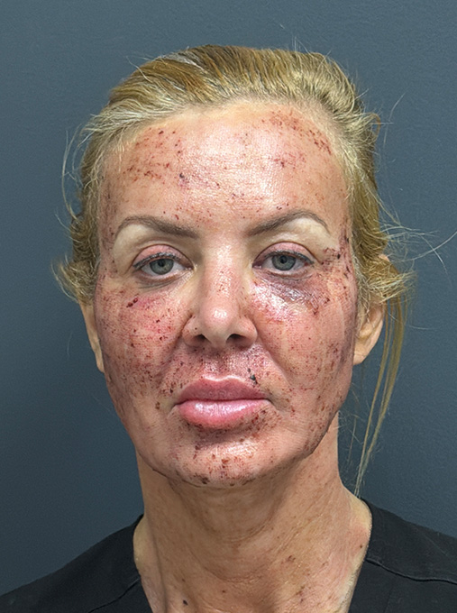 1 week post ProFractional Laser