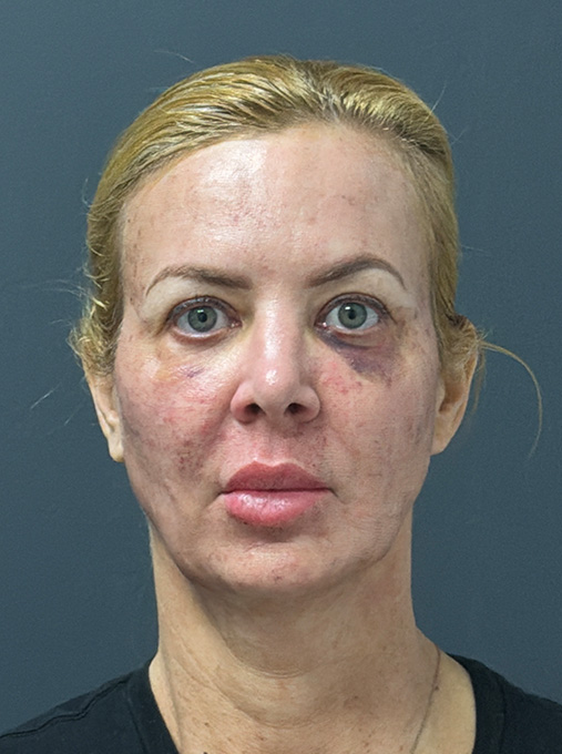 1 week post ProFractional Laser