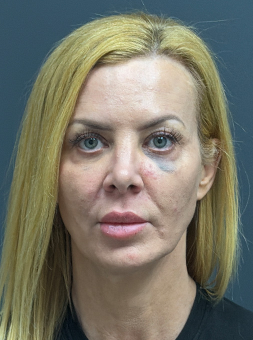 1 week post ProFractional Laser