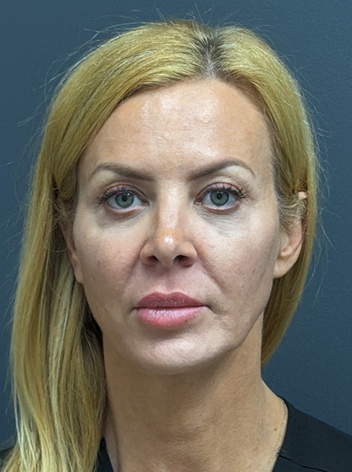 1 week post ProFractional Laser